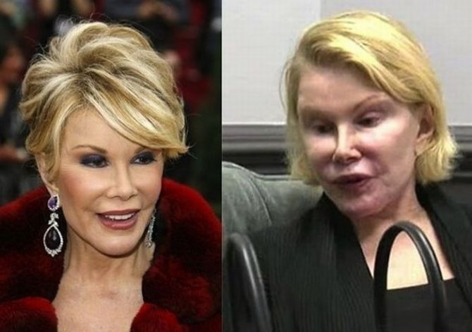 Джоан Риверс - рекордсменка по пластическим операциям