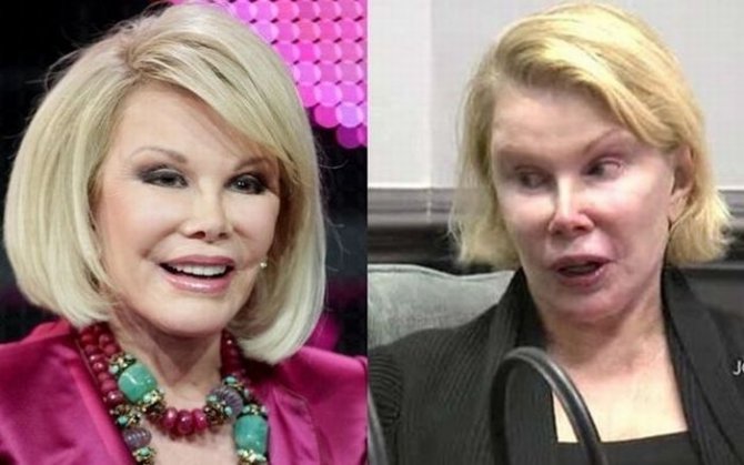 Джоан Риверс - рекордсменка по пластическим операциям