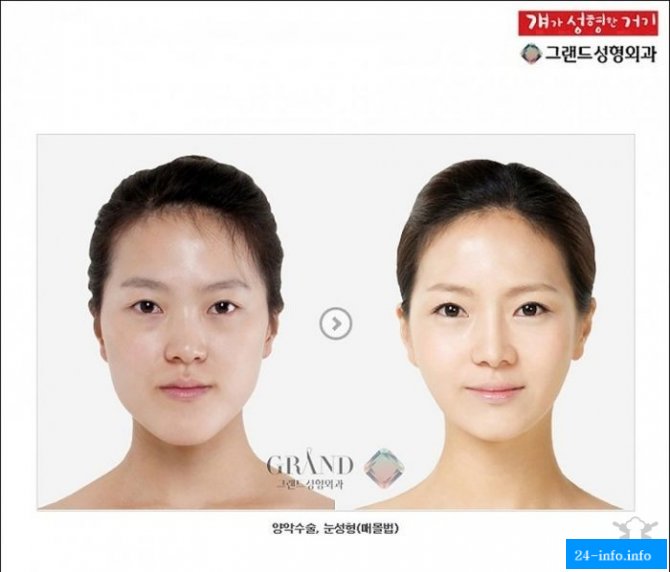 Бум пластической хирургии в Корее