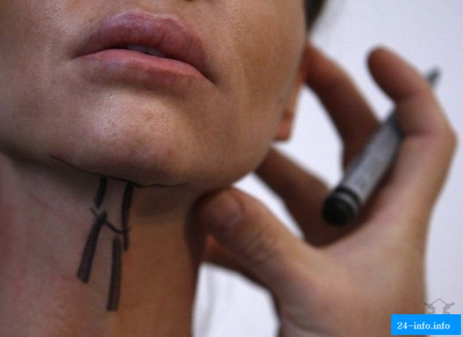 Бум пластической хирургии в Корее