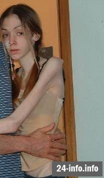 Болезнь худобы - анорексия Болезнь худобы - анорексия