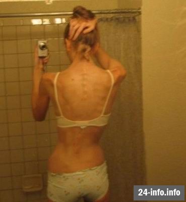 Болезнь худобы - анорексия Болезнь худобы - анорексия