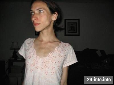 Болезнь худобы - анорексия Болезнь худобы - анорексия