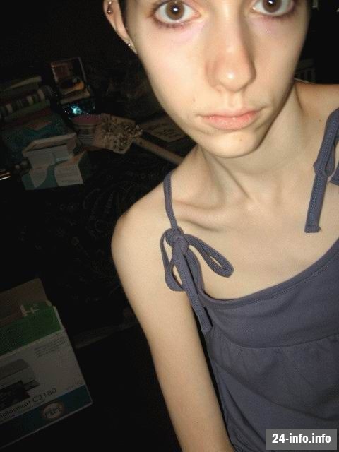 Болезнь худобы - анорексия Болезнь худобы - анорексия