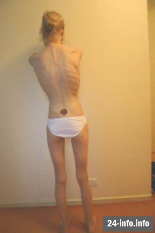 Болезнь худобы - анорексия Болезнь худобы - анорексия