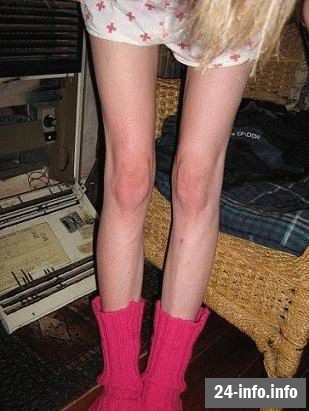 Болезнь худобы - анорексия Болезнь худобы - анорексия