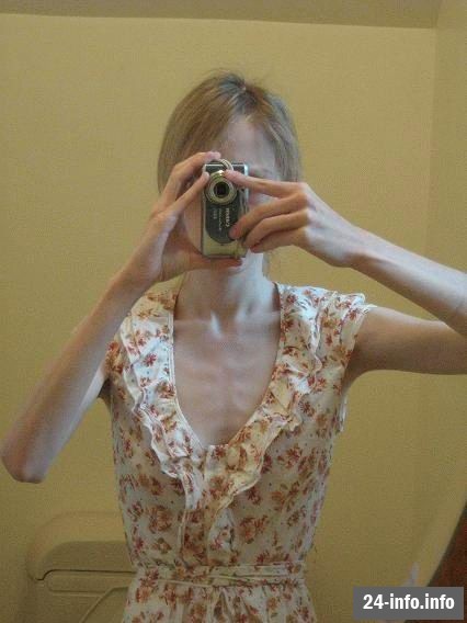 Болезнь худобы - анорексия Болезнь худобы - анорексия