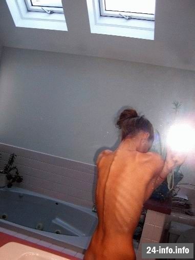 Болезнь худобы - анорексия Болезнь худобы - анорексия