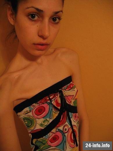 Болезнь худобы - анорексия Болезнь худобы - анорексия