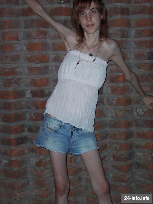 Болезнь худобы - анорексия