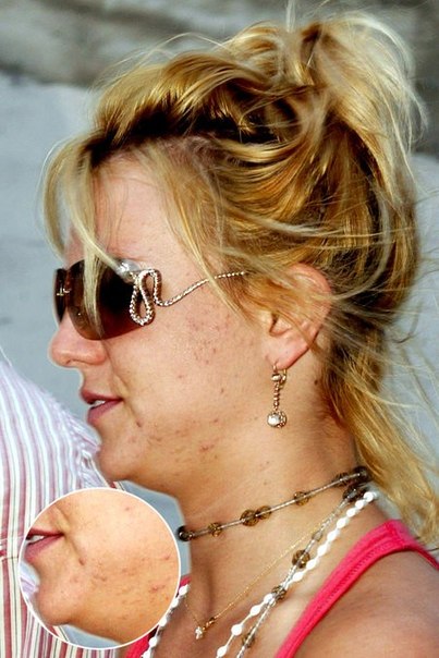 У Бритни Спирс проблемная кожа