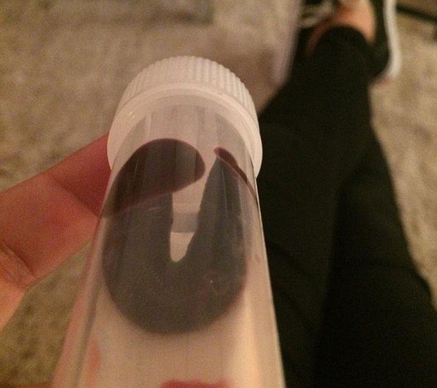 Девушке вытащили пиявку Девушке вытащили пиявку