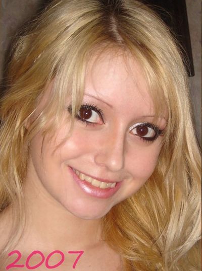 Девушка до и после операции