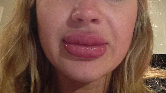 Девушка купила в интернете увеличитель губ...