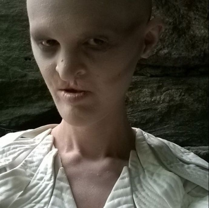 Модель с редким генетическим расстройством не хочет меняться