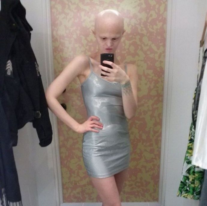 Модель с редким генетическим расстройством не хочет меняться