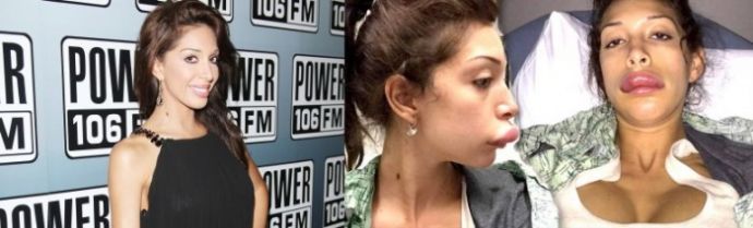 Неудачные пластические операции звезд