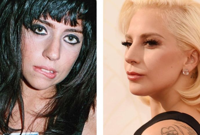 Знаменитости, решившие уменьшить свой нос