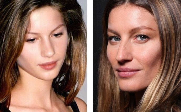 Знаменитости, решившие уменьшить свой нос