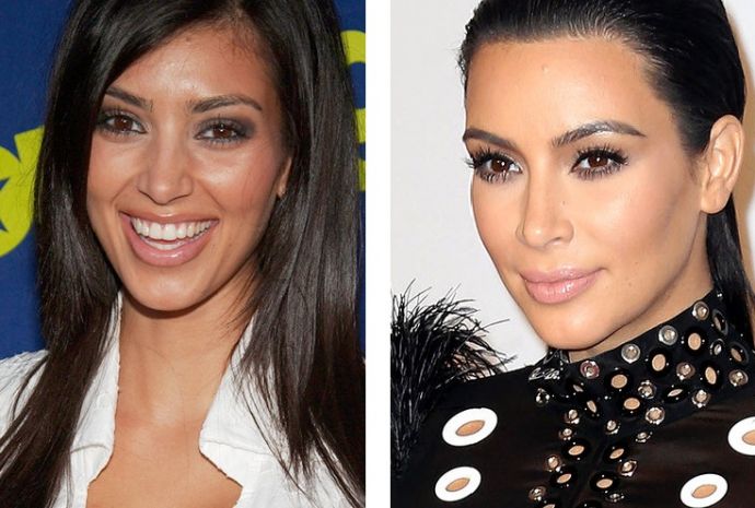 Знаменитости, решившие уменьшить свой нос