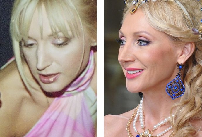 Знаменитости, решившие уменьшить свой нос