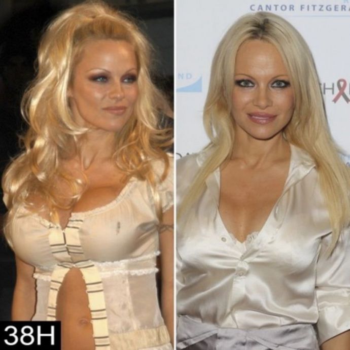 Знаменитости, которые уменьшили грудь