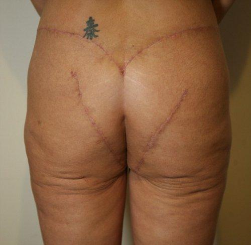 После пластики ягодицы выглядели, как после укуса акулы После пластики ягодицы выглядели, как после укуса акулы