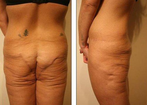 После пластики ягодицы выглядели, как после укуса акулы После пластики ягодицы выглядели, как после укуса акулы