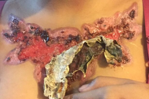 Последствия выведения тату с сисек студентки Последствия выведения тату с сисек студентки