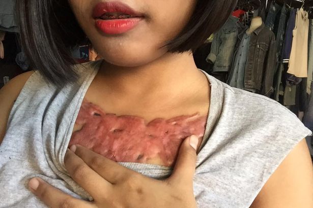 Последствия выведения тату с сисек студентки Последствия выведения тату с сисек студентки