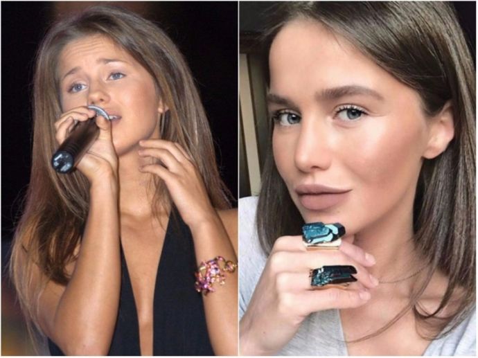 Как изменились лица российских звёзд до и после пластических операций