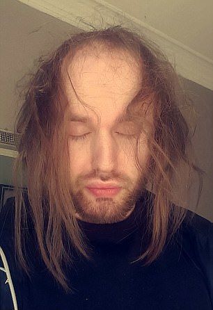 Новая шевелюра для лысого гея