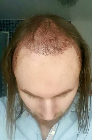 Новая шевелюра для лысого гея Новая шевелюра для лысого гея