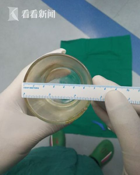 Пациент отказался объяснять врачам, откуда в его заднице взялся стакан Пациент отказался объяснять врачам, откуда в его заднице взялся стакан