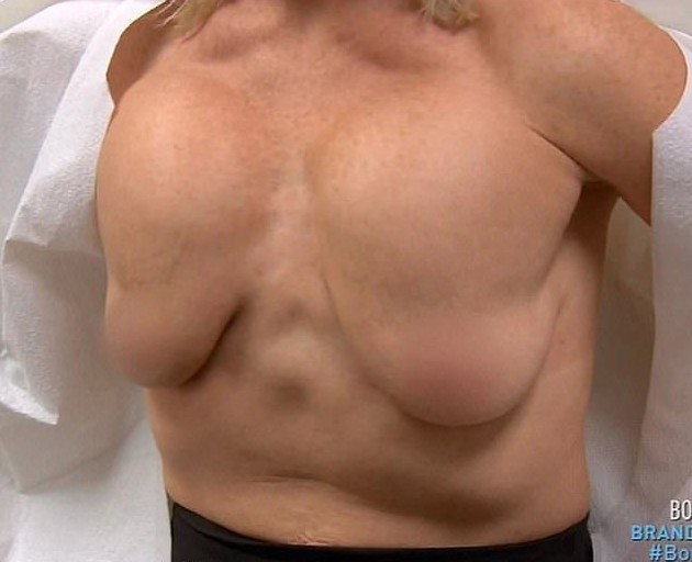 После неудачной операции по увеличению груди женщина вынуждена крепить ее скотчем