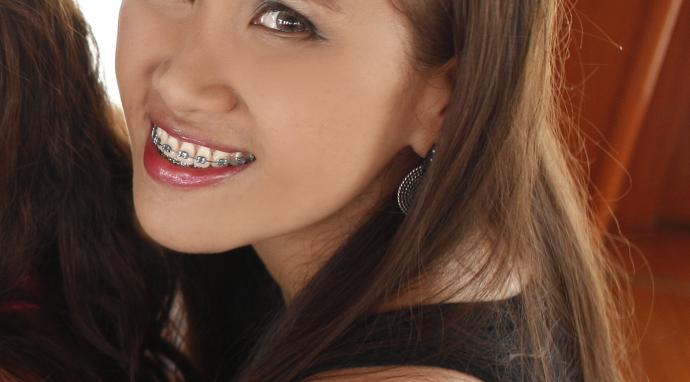 Девушки с брекетами на зубах