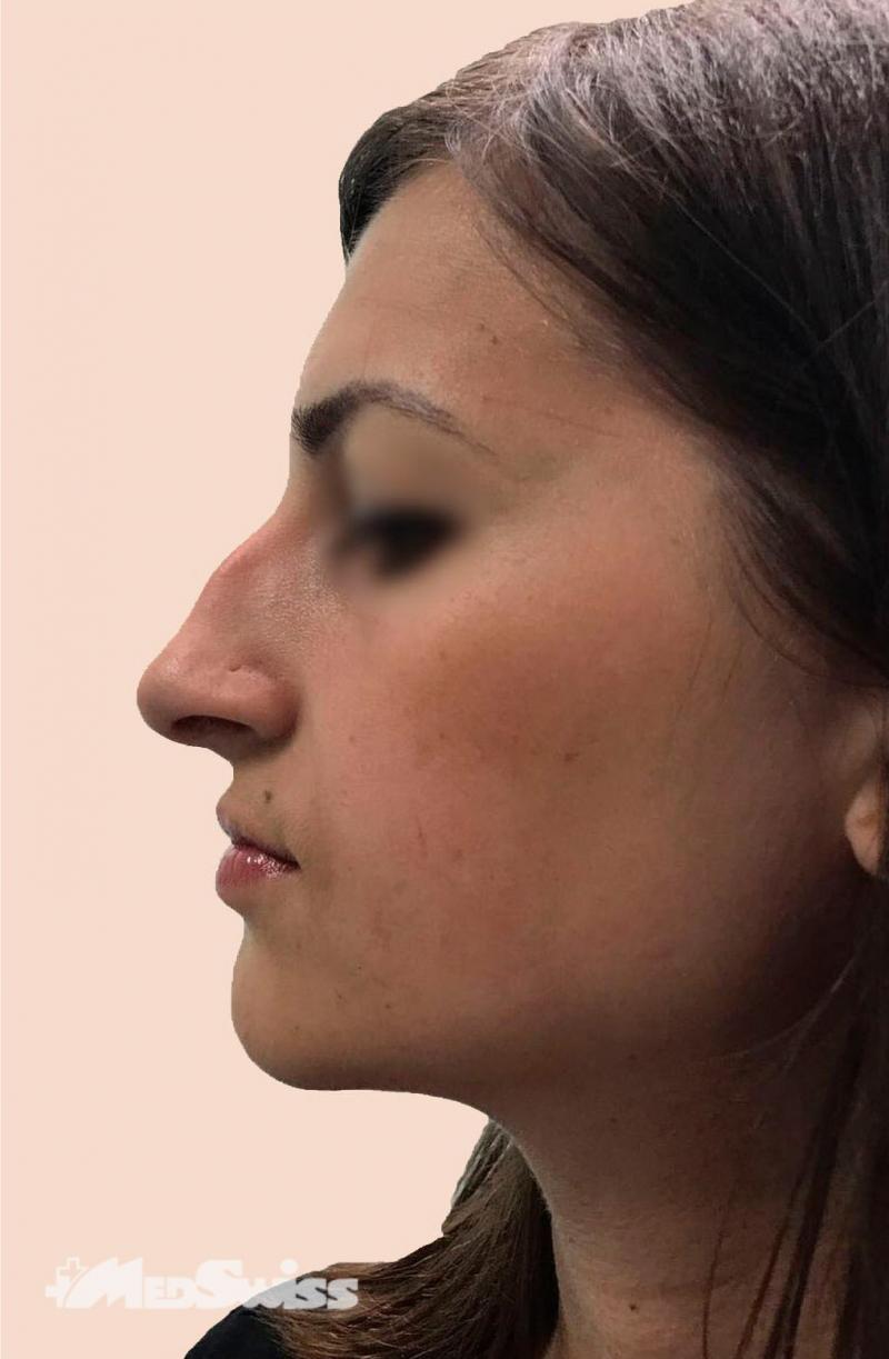 Некрасивый нос у девушки
