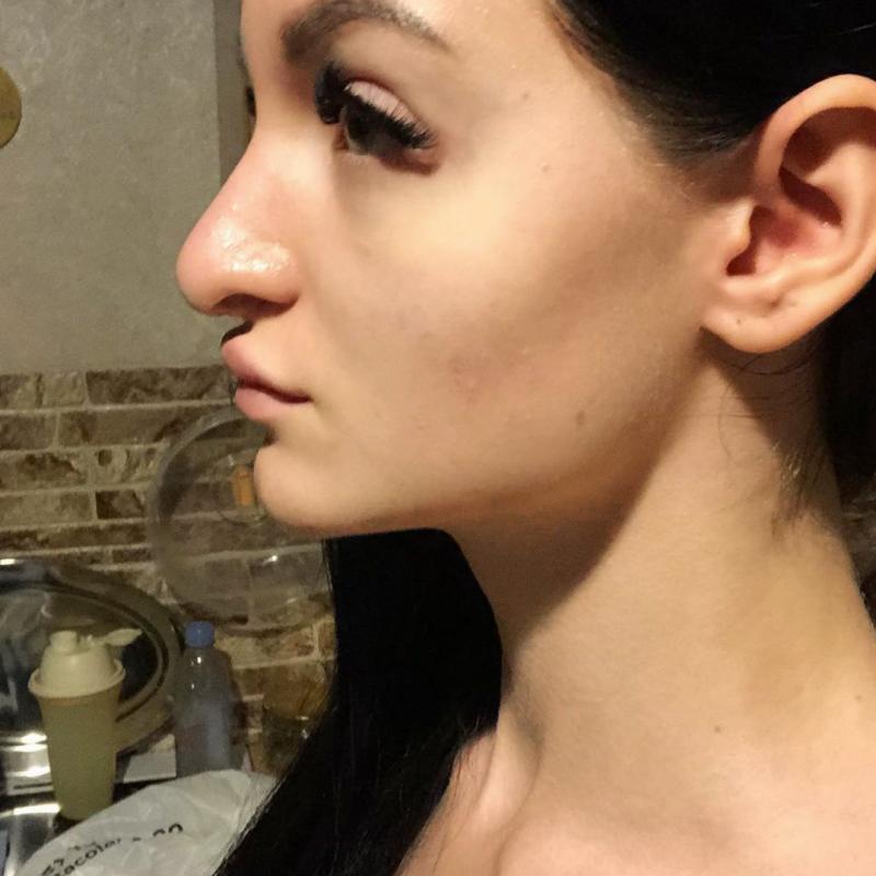 Утиный нос у женщин