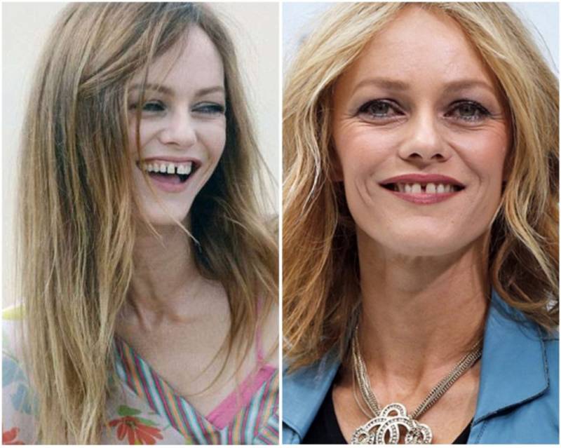 Изменение улыбки знаменитостей: от кривых зубов до совершенства